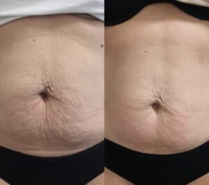 How to Get Rid of My Post-Pregnancy Belly Fat?